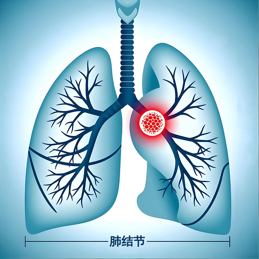 查出肺结节，急着“动刀子”并不明智