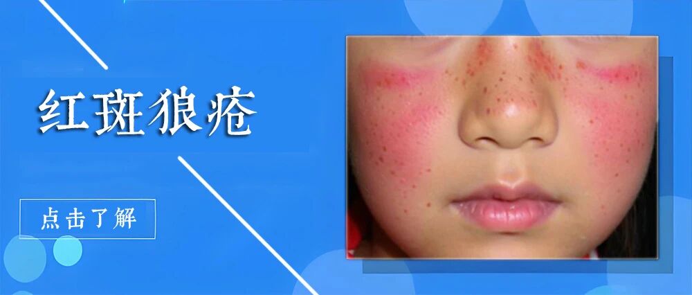 不必谈“狼”色变!带您正确认识红斑狼疮